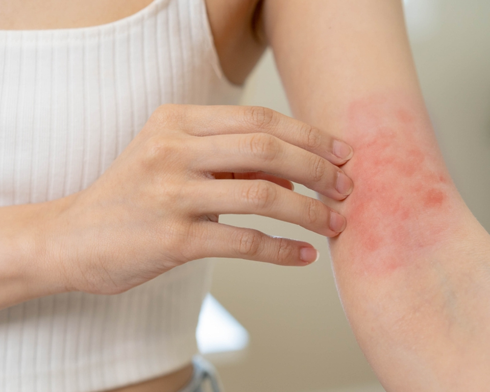 Understanding Common Flexural Eczema Triggers and How to Prevent Them