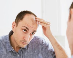 man looking his head affected by frontal fibrosing alopecia