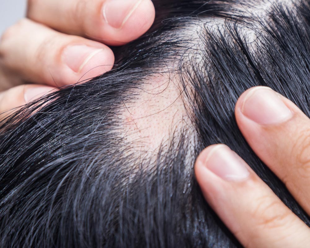 Lichen Planopilaris: Hair Loss, Scalp Pain, Treatment
