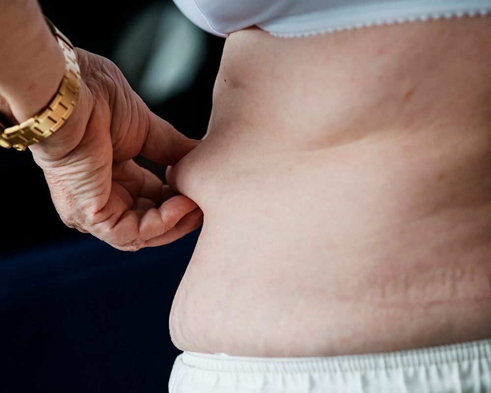 What is Sarcopenic Obesity? Understanding the Growing Concern